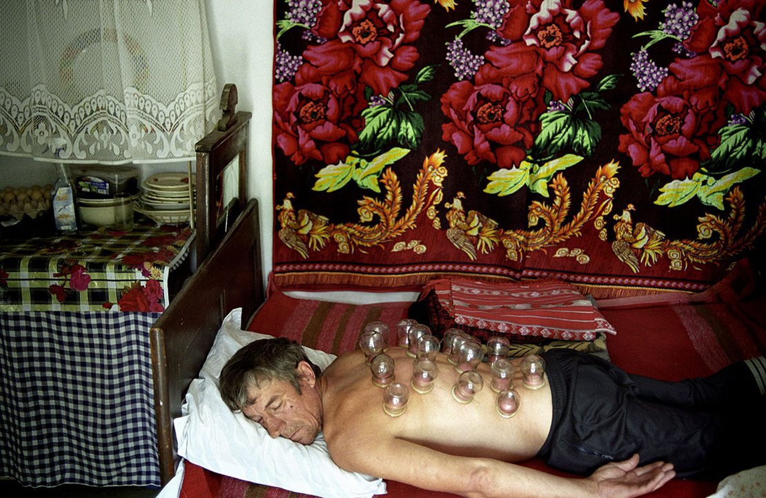 Senia Sava, 40 years old, suffering for epilepsy, receives a traditional treatment, with suction cups, to relieve his back pains caused by a flu.
